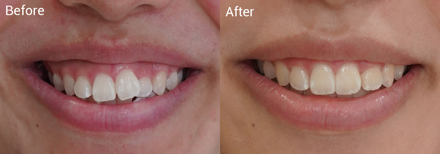 前歯の並びが気になる