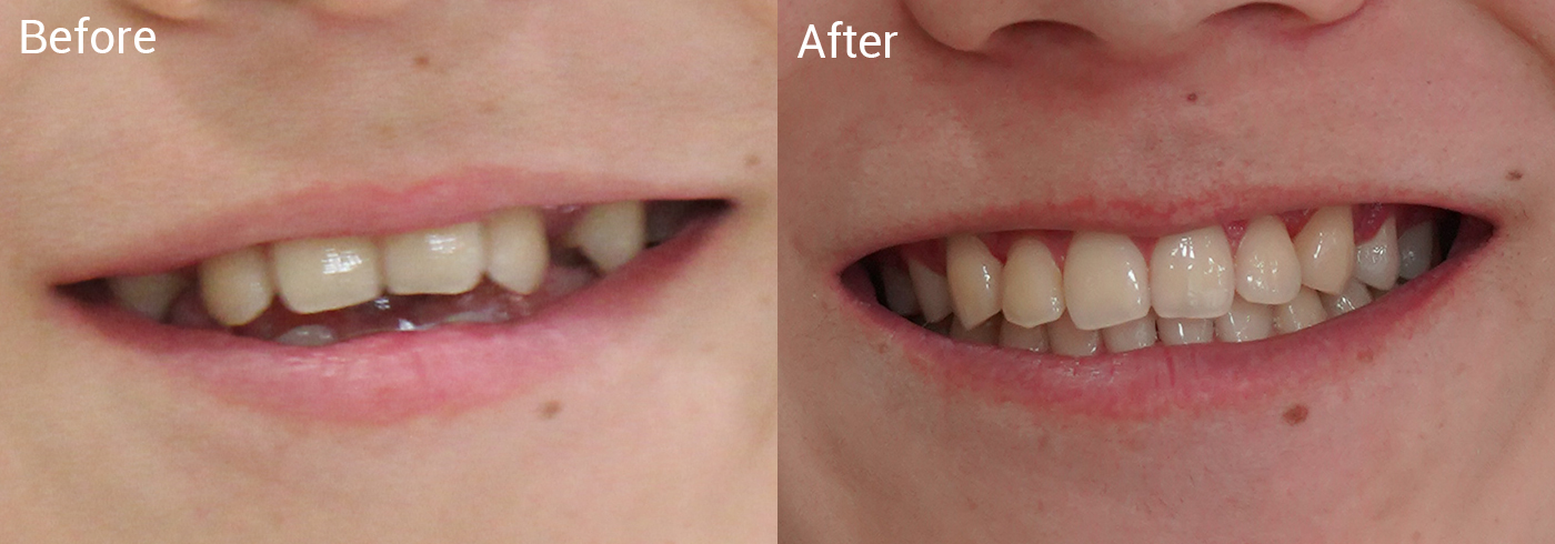 ガタガタの歯並び（叢生）が気になる