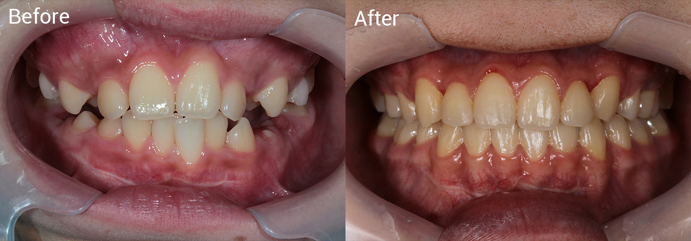 ガタガタの歯並び（叢生）が気になる