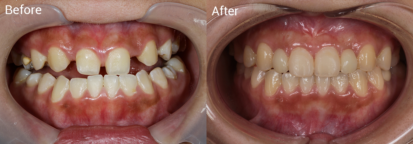 歯並びが気になる