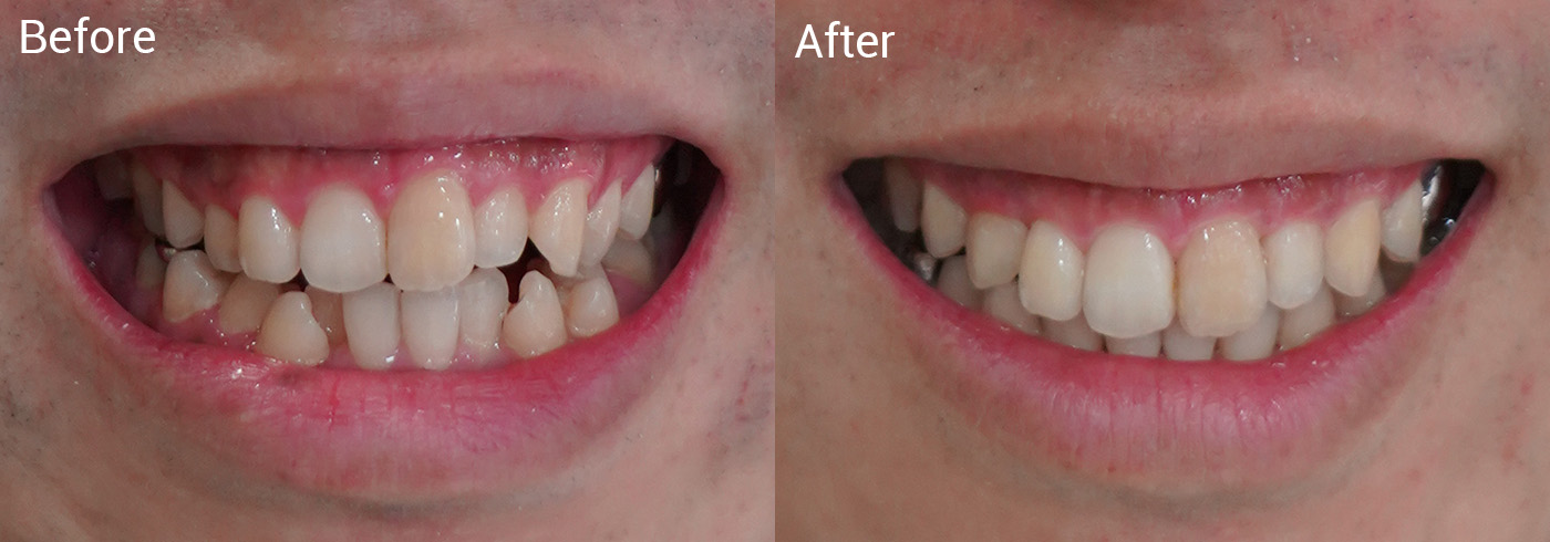 歯並びが気になる、咬み合わせが悪い