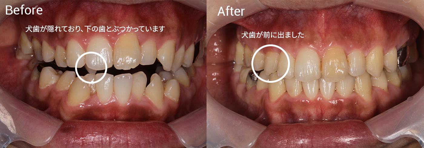歯並びが気になる、咬み合わせが悪い