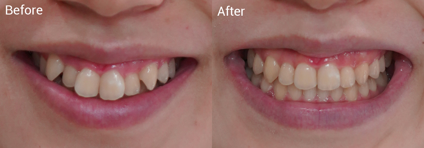 顎関節が痛くて口を開けられない、歯並びが気になる