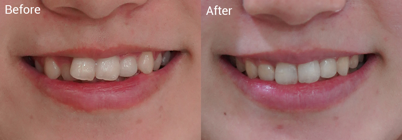 歯並びが気になる