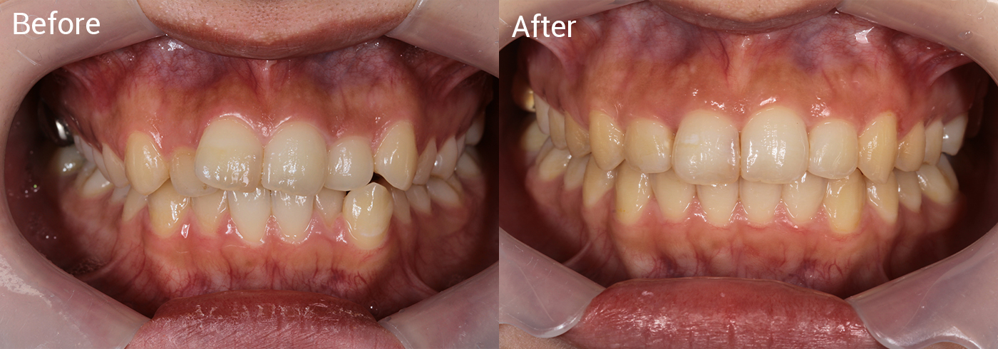 歯並びが気になる