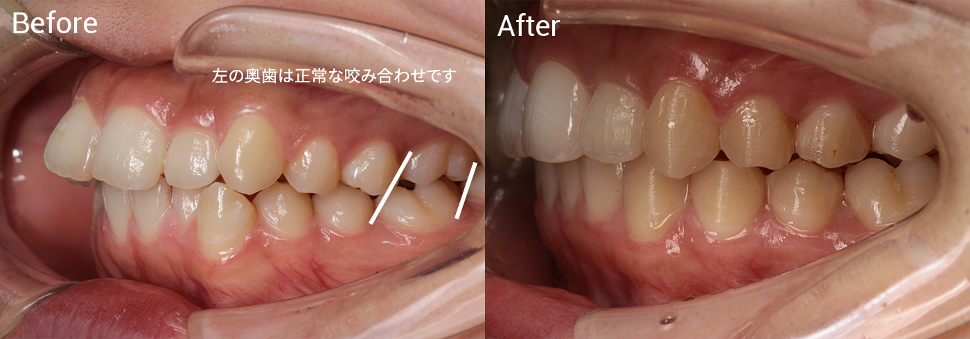 歯並びが気になる