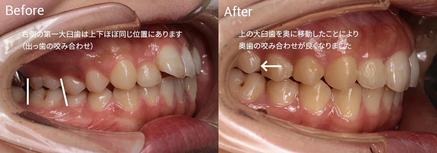 歯並びが気になる