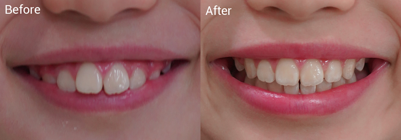 出っ歯が気になる