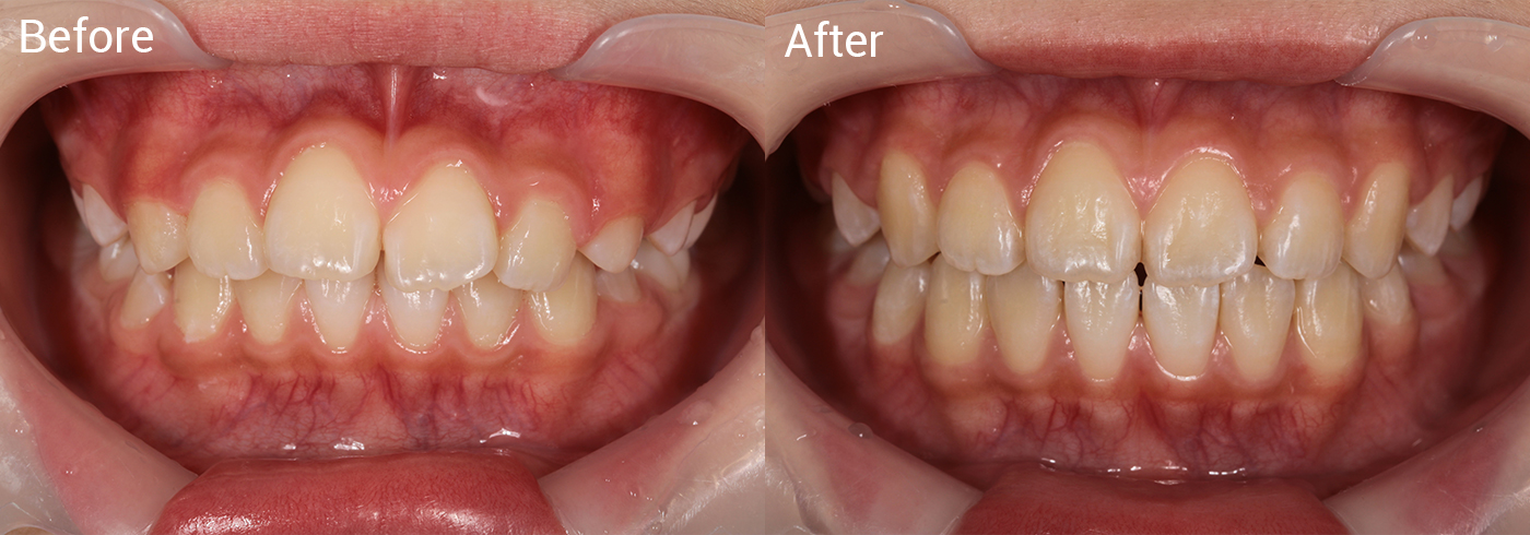 出っ歯が気になる