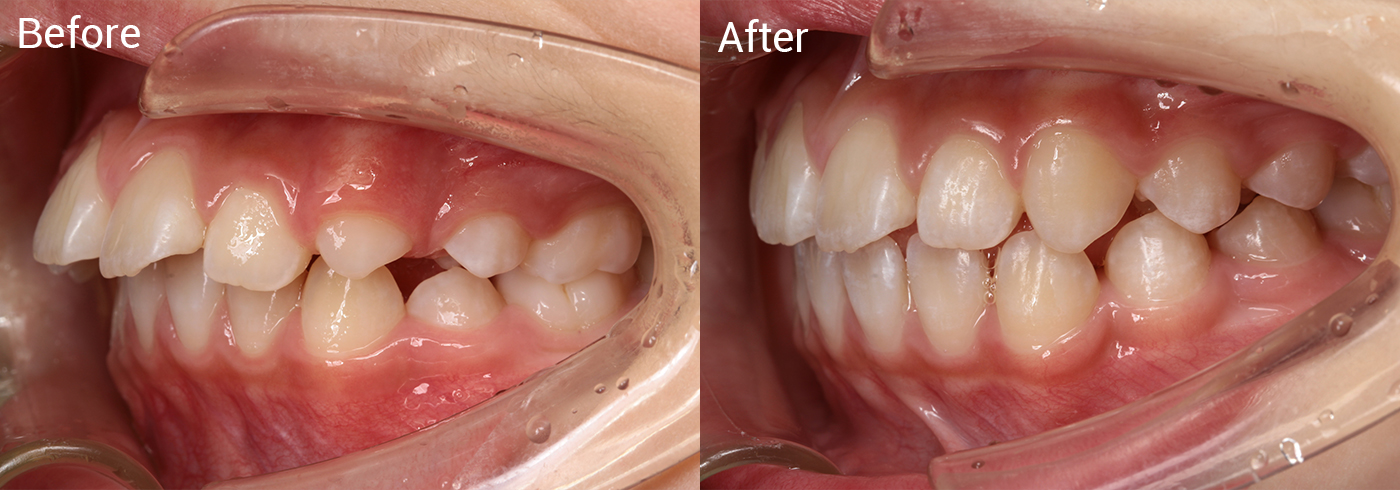 出っ歯が気になる
