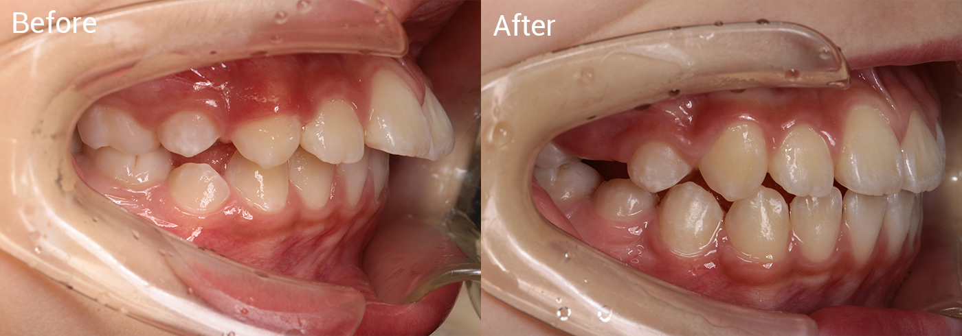 出っ歯が気になる