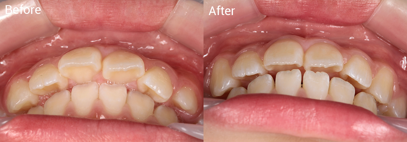 出っ歯が気になる