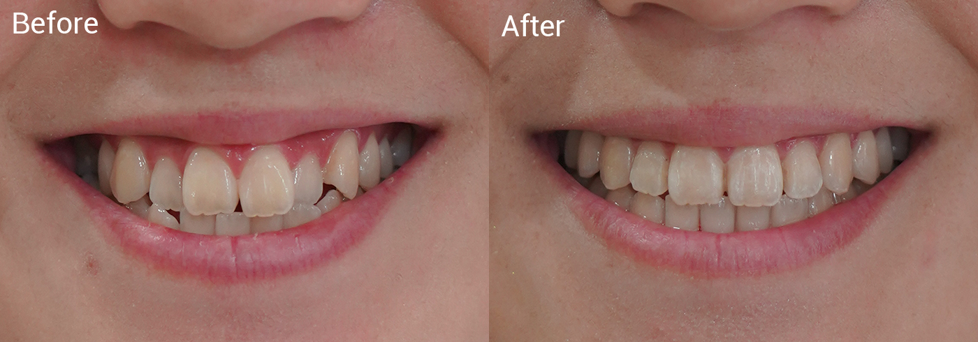 歯並びが気になる