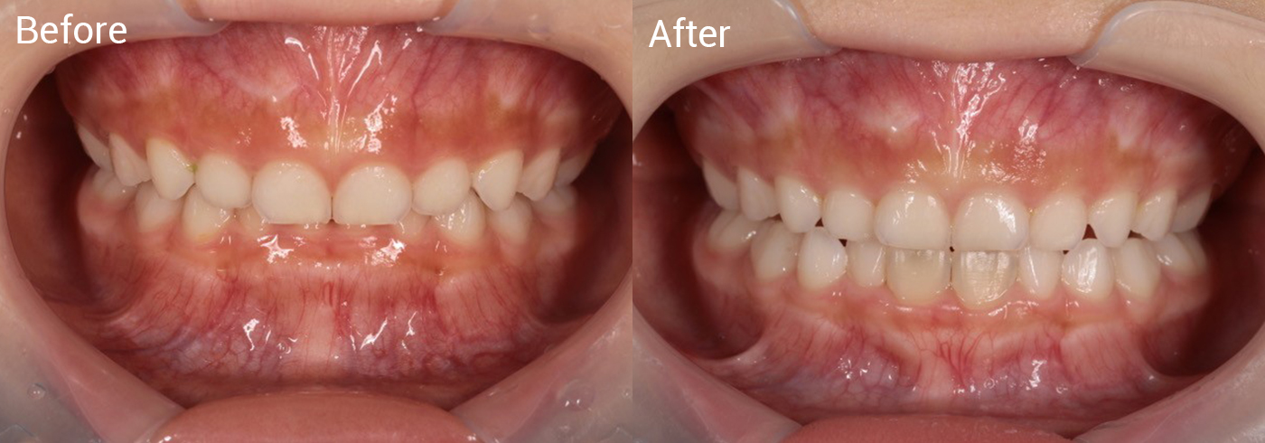 過蓋咬合（上の前歯が下の前歯に覆いかぶさる状態）