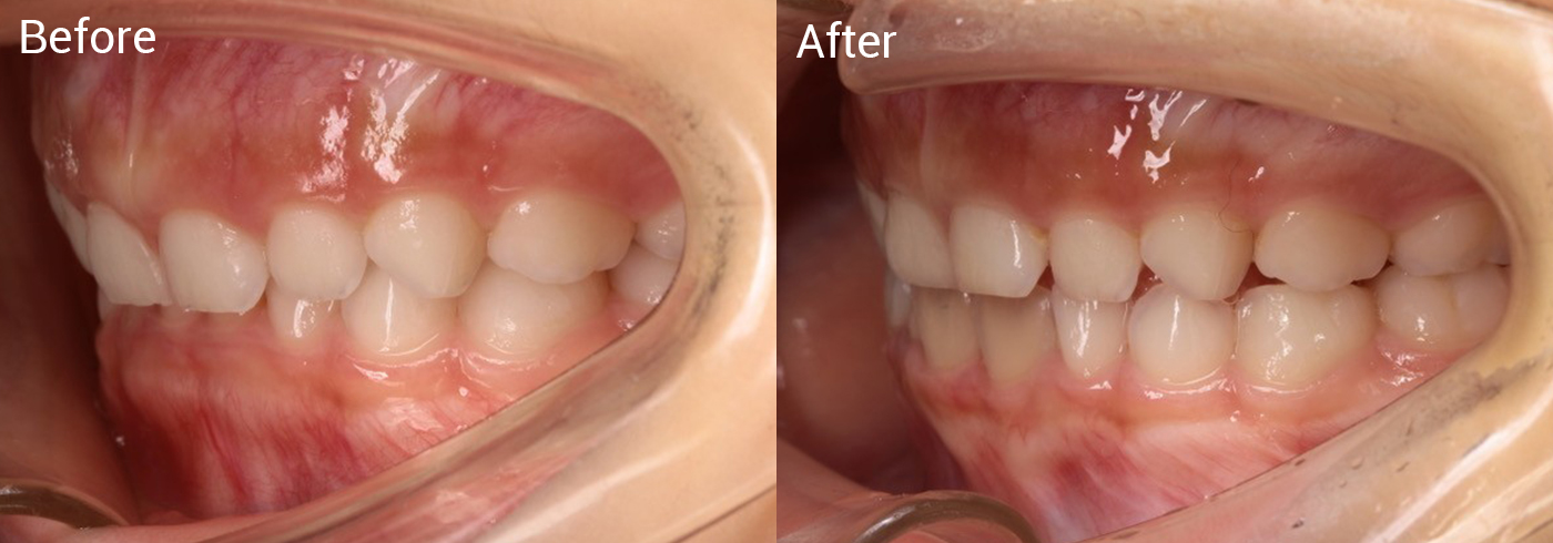 過蓋咬合（上の前歯が下の前歯に覆いかぶさる状態）