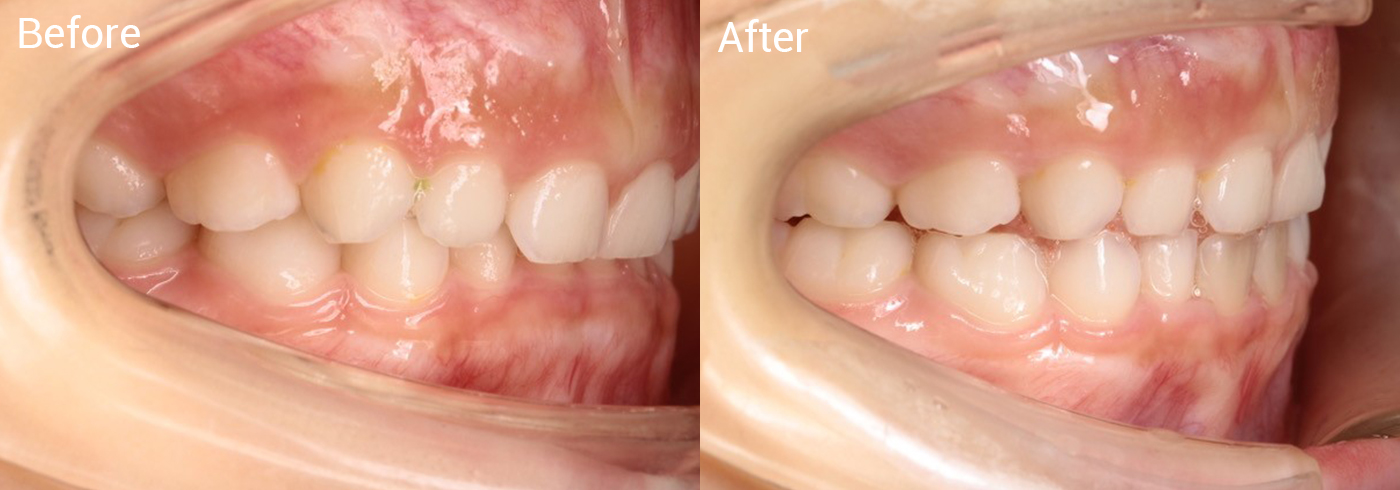 過蓋咬合（上の前歯が下の前歯に覆いかぶさる状態）