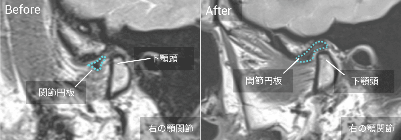 前歯の突出が気になる